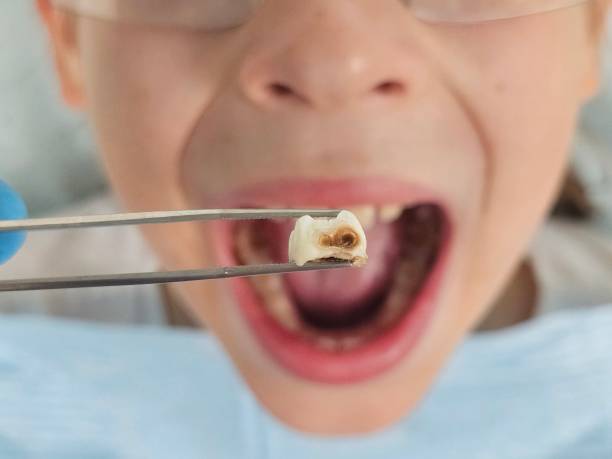 Best Emergency Wisdom Teeth Removal in Burnt Store Marina, FL