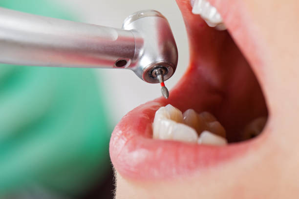 Best Emergency Broken Tooth Repair in Burnt Store Marina, FL
